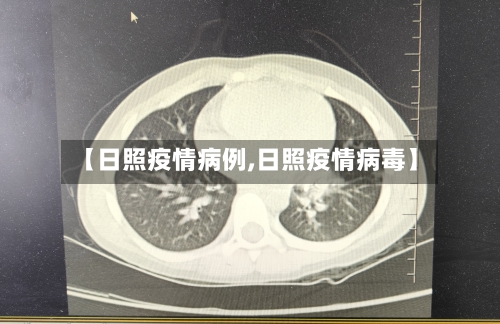 【日照疫情病例,日照疫情病毒】