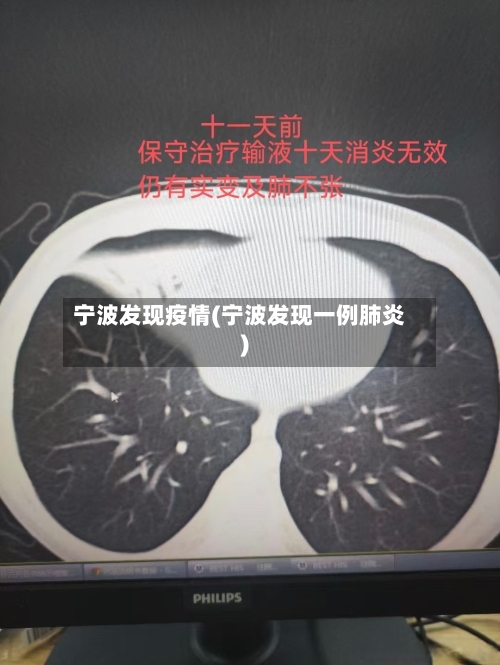 宁波发现疫情(宁波发现一例肺炎)