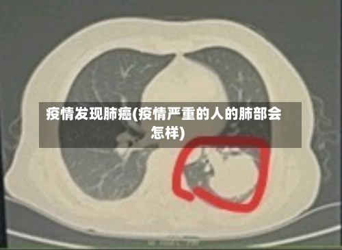 疫情发现肺癌(疫情严重的人的肺部会怎样)-第3张图片