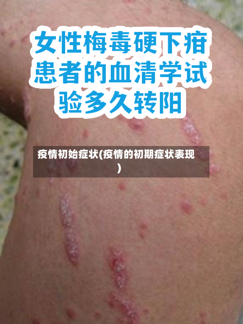 疫情初始症状(疫情的初期症状表现)-第3张图片