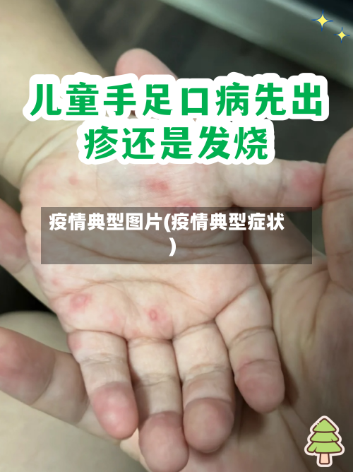 疫情典型图片(疫情典型症状)-第2张图片