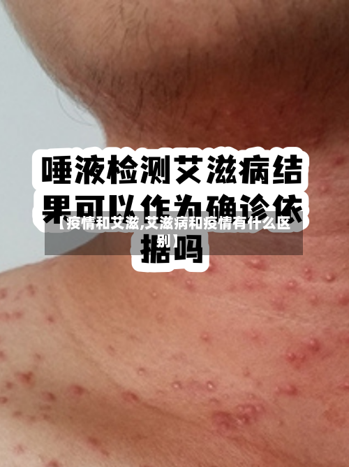 【疫情和艾滋,艾滋病和疫情有什么区别】-第1张图片