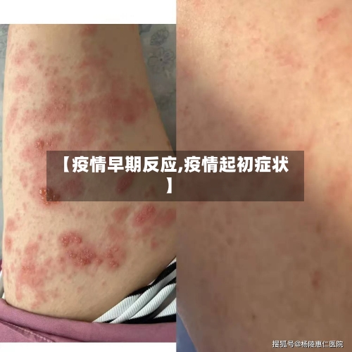 【疫情早期反应,疫情起初症状】