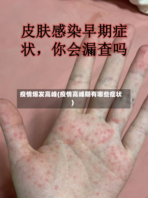 疫情爆发高峰(疫情高峰期有哪些症状)