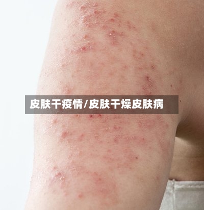 皮肤干疫情/皮肤干燥皮肤病