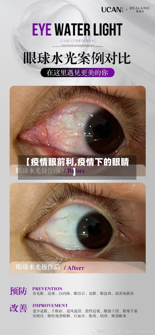 【疫情眼前利,疫情下的眼睛】-第1张图片