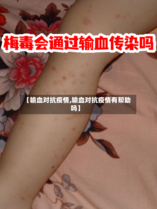 【输血对抗疫情,输血对抗疫情有帮助吗】-第1张图片