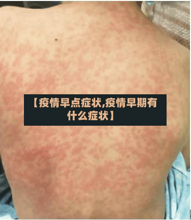 【疫情早点症状,疫情早期有什么症状】-第3张图片