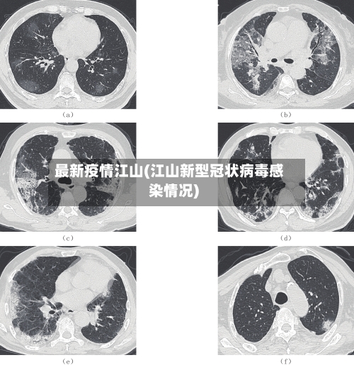 最新疫情江山(江山新型冠状病毒感染情况)-第1张图片