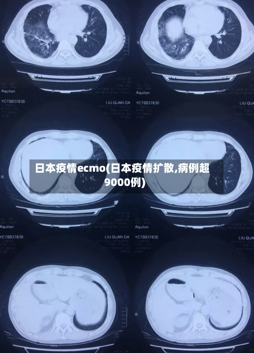 日本疫情ecmo(日本疫情扩散,病例超9000例)