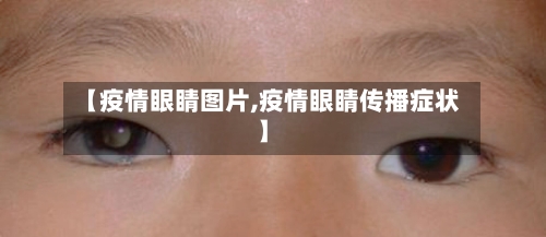 【疫情眼睛图片,疫情眼睛传播症状】