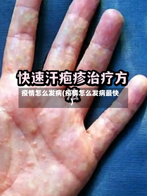 疫情怎么发病(疫情怎么发病最快)-第3张图片