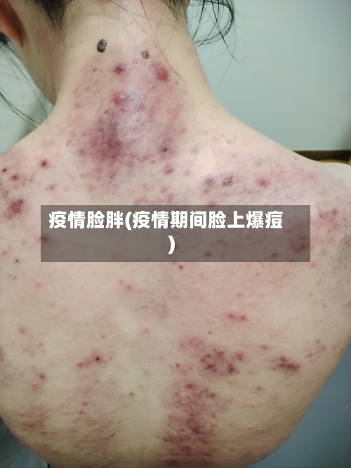 疫情脸胖(疫情期间脸上爆痘)