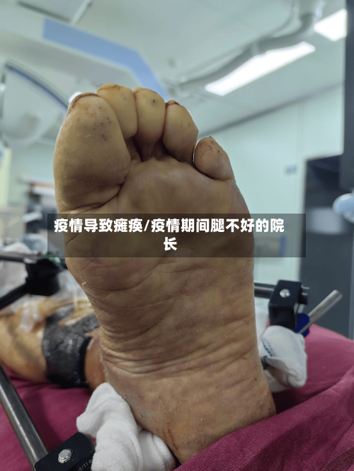 疫情导致瘫痪/疫情期间腿不好的院长-第3张图片