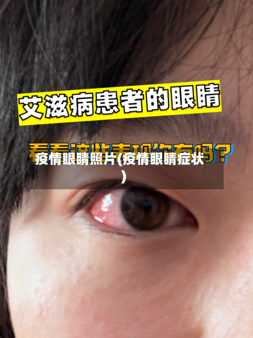 疫情眼睛照片(疫情眼睛症状)-第2张图片