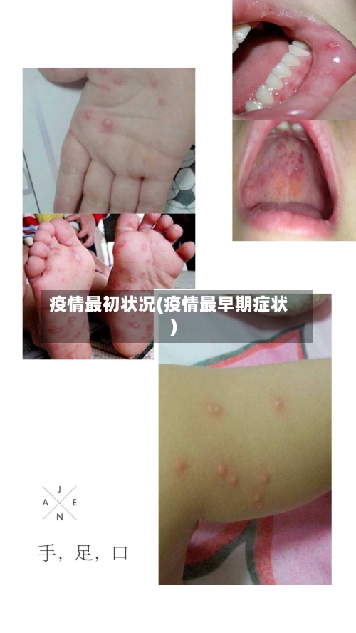疫情最初状况(疫情最早期症状)-第1张图片