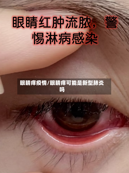 眼睛痒疫情/眼睛痒可能是新型肺炎吗-第2张图片