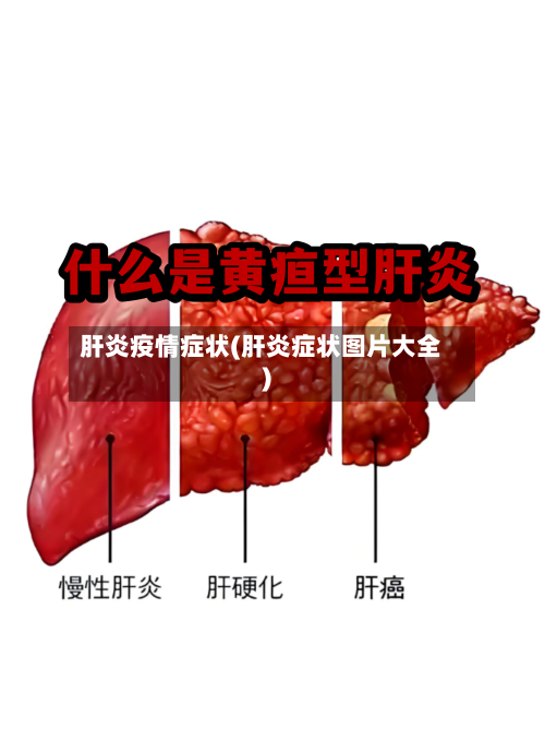 肝炎疫情症状(肝炎症状图片大全)-第2张图片
