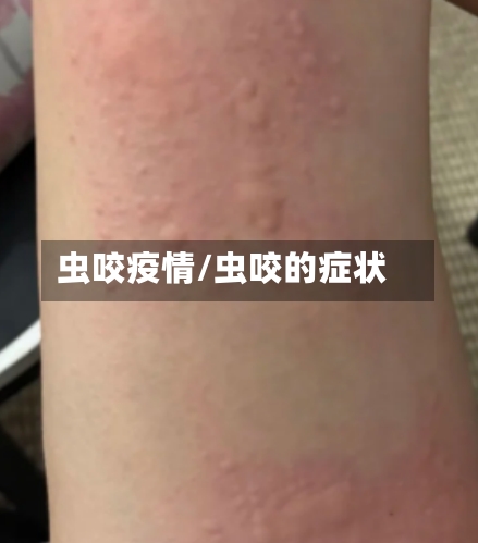 虫咬疫情/虫咬的症状-第1张图片